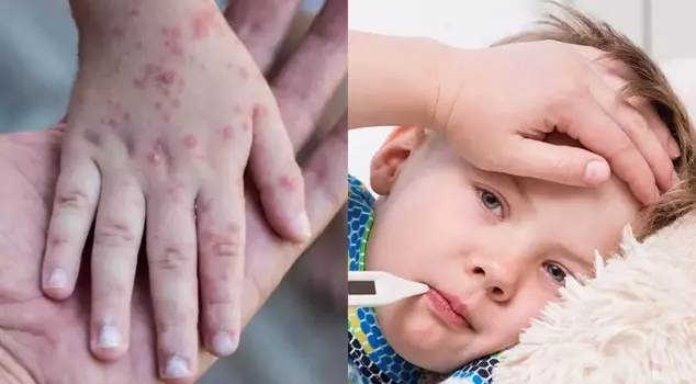 Experts warn against measles and whooping cough: Cases are increasing, precautions need to be taken.