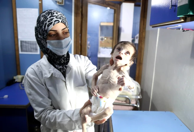 وفاة طفلين بسبب سوء التغذية في غوطة دمشق المحاصرة
