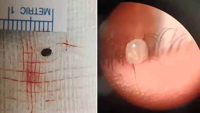 He went to the hospital complaining of eye pain, and a live tick came out of his eye.