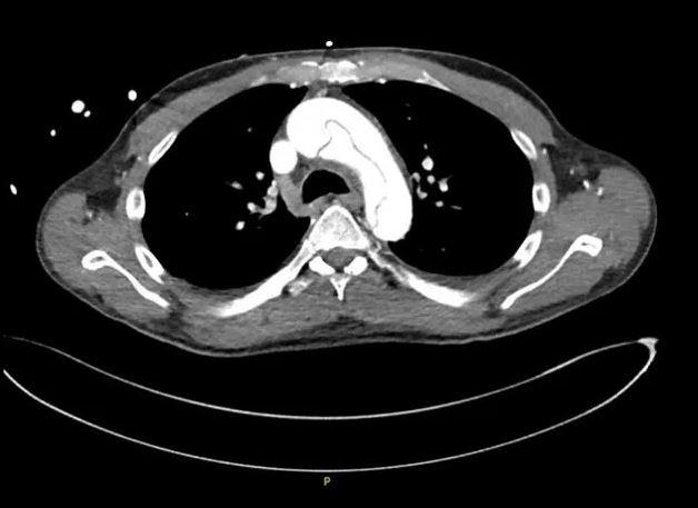 The 59-year-old man tore his aorta while masturbating