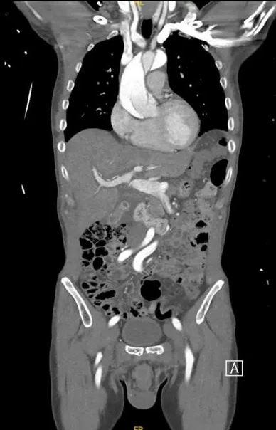 The 59-year-old man tore his aorta while masturbating