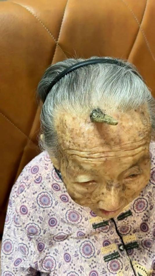 A horn appeared on the forehead of a 107-year-old woman in China