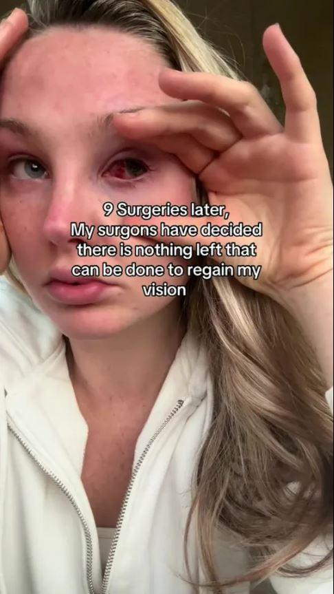 She suffered permanent vision loss in her left eye after being struck by the metal strap of a bag