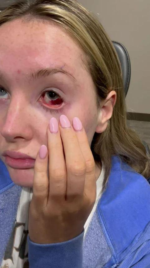 She suffered permanent vision loss in her left eye after being struck by the metal strap of a bag