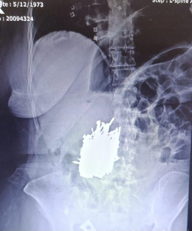 A 1-kilogram metal object was removed from a woman's stomach