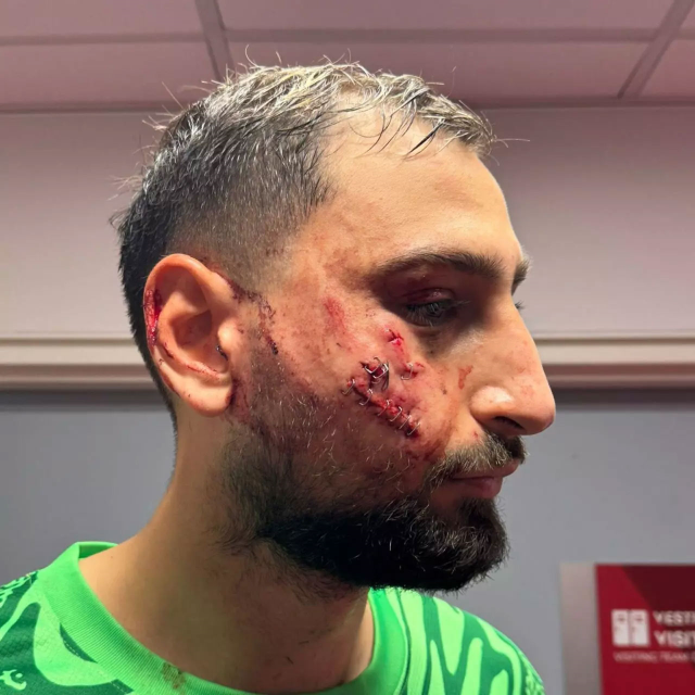 Terrible incident in the Monaco-PSG match: Donnarumma's face was injured