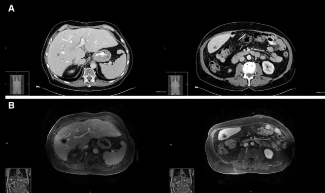 The patient died due to aggressive cancer transmitted from the donor