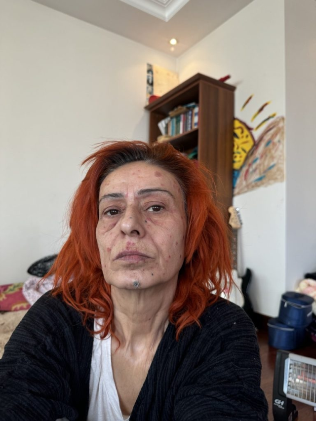 Yıldız Tilbe, who has burns on her face, covered the burn marks with colorful dyes