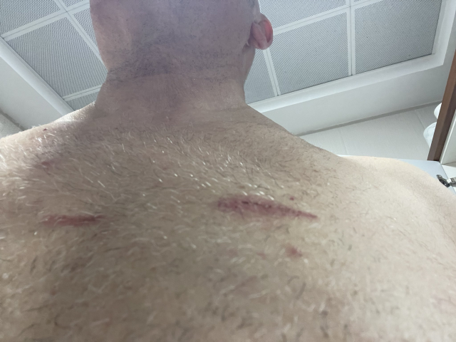 CHP member Tanal, who participated in the protest, shared the scars on his body