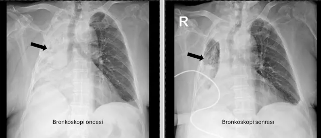 The corn kernel that got stuck in the trachea appeared 5 months later