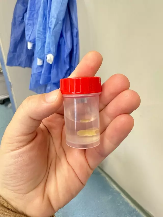 The corn kernel that got stuck in the trachea appeared 5 months later