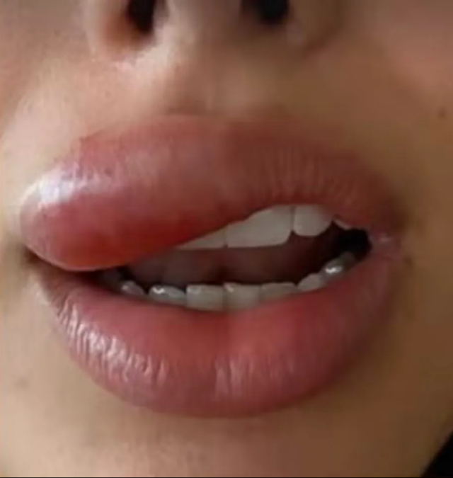 The fiancée of the famous footballer with a pimple on her lip became unrecognizable