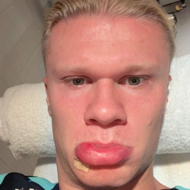 Erling Haaland had an accident! Those who see his latest state can't recognize him