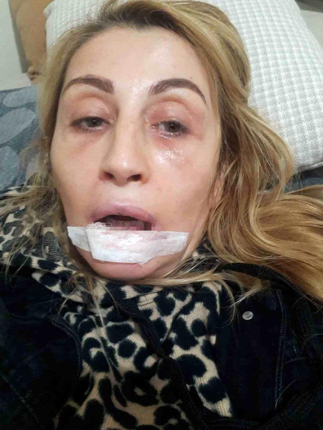 After Aesthetic Procedure, Her Lip Decayed: 7-Year Legal Struggle