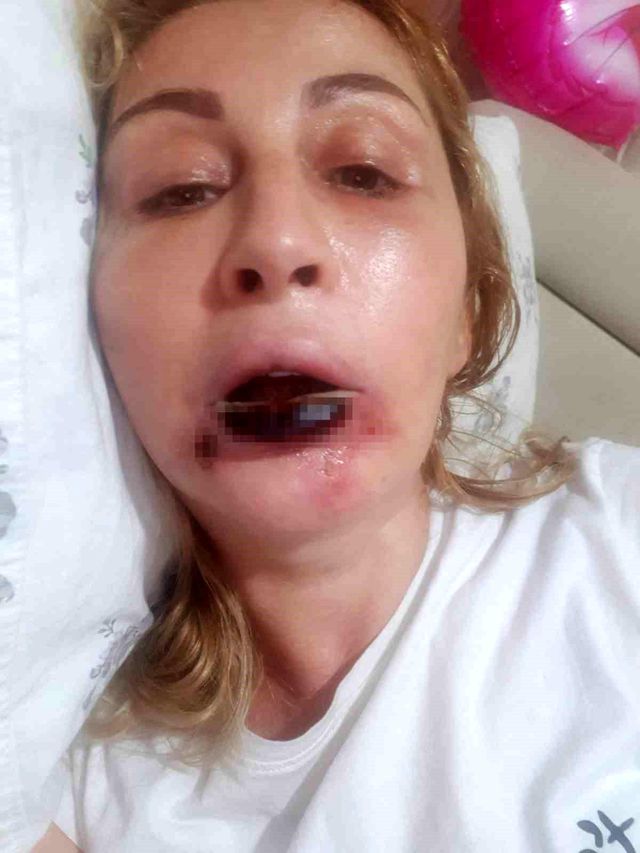 After Aesthetic Procedure, Her Lip Decayed: 7-Year Legal Struggle