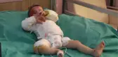 Üzerine Tencere Devrilen Suriyeli Bebek, Türk Doktorların Çabasıyla İyileşti