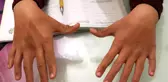 Küçük Umut Eren, 6 Parmağını Matematik Dersinde Avantaja Dönüştürdü
