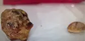 Mesanesinden 300 Gram Taş Çıktı