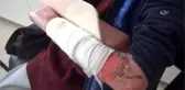 Kelebek Hastası Çocuklar, Kendilerine Uygun Olmayan Köpüklü Sargı Bezini, Derilerine Yapıştığı İçin...