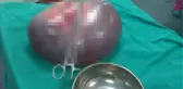 Kayserili Kadının Karnından Çıkan 9 Kiloluk Kitle, Doktorları Şaşkına Çevirdi
