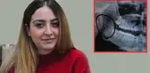 3 Yaşında Bademcik Ameliyat Oldu, Boğazında Unuttukları İğne ile 18 Yıl Yaşadı