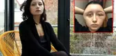 Saç Boyasının Açtığı Alerji Nedeniyle Ölümden Döndü