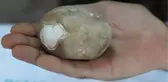 İdrarını Yapamayan Vatandaşın Mesanesinden 522 Gramlık Tek Parça Taş Çıktı