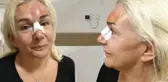 Yüzüstü Düşerek Yaralanan Oyuncu Burçin Orhon: Kim Nazar Ediyorsa Çeksin Gözlerini