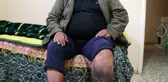 Varis ameliyatı oldu, fil hastası çıktı