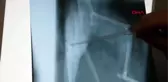 OSMANİYE 3'üncü kattan düşünce bacağı kırılan kedi ameliyatla sağlığına kavuştu