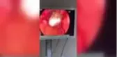Yakalanmamak için yuttuğu uyuşturucu endoskopi ile çıkartıldı