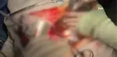 Almanya'da 4 ayrı ameliyat önerilen kanser hastası Türkiye'de tek ameliyat ile şifa buldu