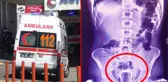 Hacamat faciayla bitti! Makatına çay bardağı kaçan adam, rezaleti 1 hafta sonra fark etti