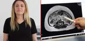 Yıllardır karnı şiş gezen kadının vücudundan 9 aylık bebek büyüklüğünde kist çıkarıldı