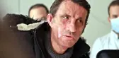 Türkiye'nin ilk yüz nakli 10 yaşında