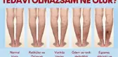 TEDAVİ EDİLMEYEN VARİSE DİKKAT; ÖMÜR BOYU VARİS ÇORABI GİYMEK ZORUNDA KALABİLİRSİNİZ