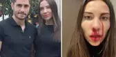 Kanlar içinde kalan eşinin iddialarına Özer Hurmacı'dan cevap geldi: Hepsi yalan, o beni ısırdı