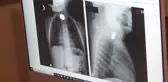 Çocuklarda boğaza kaçan cisimlere bilinçli müdahale hayat kurtarabilir
