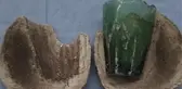 Karın ağrısı şikayetiyle hastaneye giden kadının cinsel organından bardak çıktı