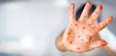 Hastalığın 6 önemli belirtisi var! Maymun çiçeği hızla yayılıyor, tecrit kararı alan ülke bile var