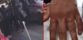 İstanbul'da maymun çiçeği alarmı! Ellerinde yaralar çıkan 3 kişi ekipler tarafından alındı, test sonuçları bekleniyor