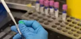 Türkiye'de ilk vaka görüldü, herkes belirtilerini merak ediyor! İşte maymun çiçeğiyle ilgili tüm soruların yanıtları