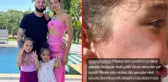 Berkay Şahin'in kızının yüzüne dolap kapağı düştü! Yaralanan evladını paylaşan anne, ateş püskürdü