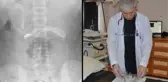 Şiddetli ağrıyla hastaneye giden çocuğun midesinden 1 metrelik şarj kablosu çıktı