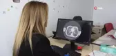 Kistik Fibrozis Hastalığında Erken Tanının Önemi
