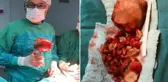 Ağrı şikayetiyle gitti, mesanesinden 1 kilogramlık taş çıkarıldı