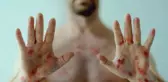 MAYMUN ÇİÇEĞİ virüsü nedir, nasıl bulaşır, belirtileri ne? Maymun çiçeği hastalığı Türkiye'de var mı?