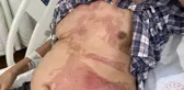 Yaşlı adam lavabo açıcının kurbanı oldu: Vücudunun yüzde 40'ı yandı