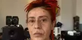 Yıldız Tilbe'nin yüzü neden yandı? Yıldız Tilbe'nin yüzü son hali nasıl?