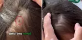 Baba, kızının kafasına yapışan keneyi böyle kopardı